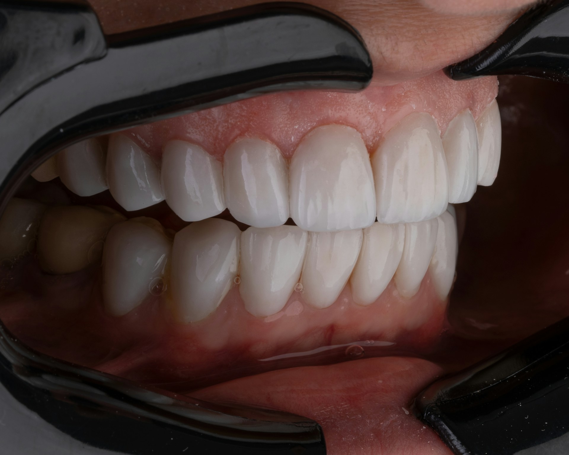 Was tun bei / gegen Zahnverlust?